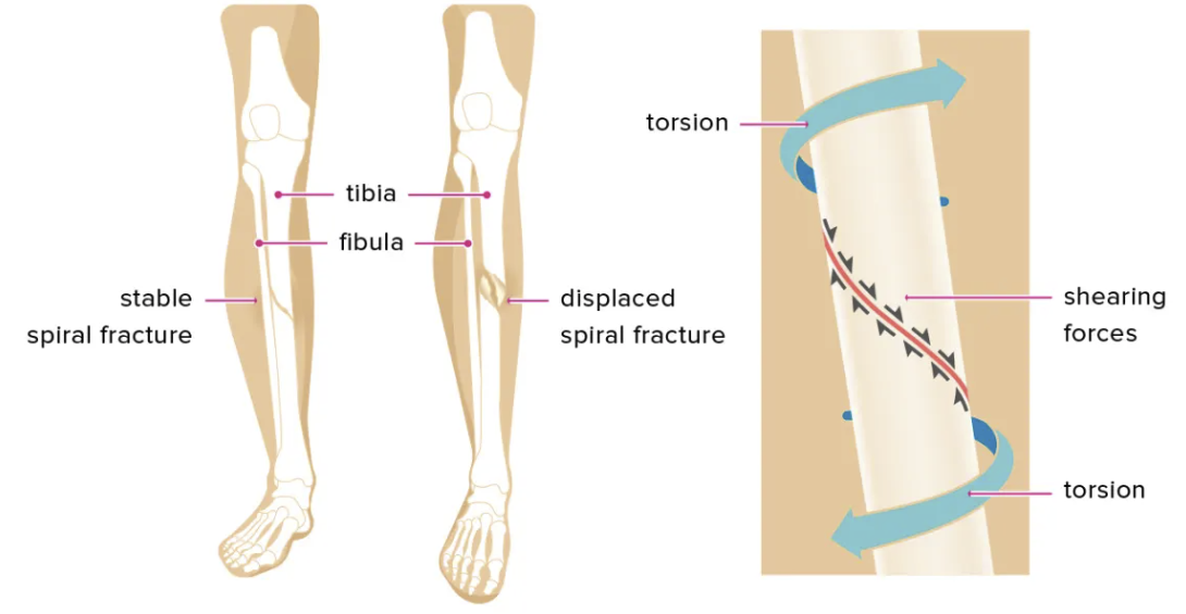 <p>a strong twisting force of a long bone that results in a complete fracture</p>