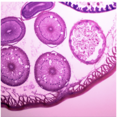 <p>200 - 500 T-cells/mm3</p><p>- Swollen lymph nodes (lymphadenopathy)</p><p>- Hairy Leukoplakia (white patch on tongue, caused by Epstein-Barr virus)</p><p>- Oral Candidiasis (yeast infection in the mouth)</p><p>Less than 200 T-cells/mm3</p><p>- Immune system severely compromised</p><p>- HIV --> AIDS</p><p>-- Persistent fever, fatigue, diarrhea, weight loss</p><p>-- HIV count in the blood is higher in the blood</p>