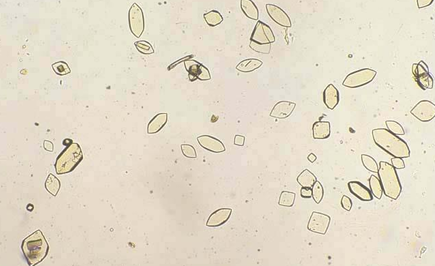 <p>Uric Acid Crystals</p>