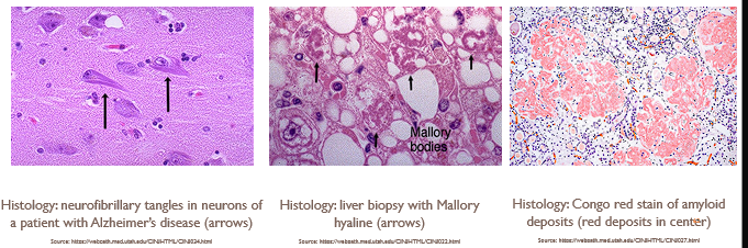 <ul><li><p><span style="font-family: "Gill Sans MT";"><strong>Mechanism of formation: </strong>Increased protein absorption in </span><span style="font-family: "Gill Sans MT"; color: red;">proximal renal tubule </span><span style="font-family: "Gill Sans MT";">(renal disease), Increased cytoskeletal proteins, increased protein production, amyloidosis, defect in intracellular transport and protein secretion.</span></p></li><li><p><span style="font-family: "Gill Sans MT";"><strong>Organs affected:</strong> liver and kidneys</span></p></li><li><p><span style="font-family: "Gill Sans MT";"><strong>Gross morphology</strong>: blue-black foci on tissue once stained</span></p></li><li><p><span style="font-family: "Gill Sans MT";"><strong>Microscopic morphology:</strong></span></p><ul><li><p><span style="font-family: "Gill Sans MT"; color: red;">Amyloidosis:</span><span style="font-family: "Gill Sans MT";"> amyloid deposits stain eosinophilic/pink-pale; pink or red on Congo red stain</span></p></li><li><p><span style="font-family: "Gill Sans MT";">Alzheimer’s disease: neurofibrillary tangles</span></p></li><li><p><span style="font-family: "Gill Sans MT";">Fatty liver: Mallory hyaline-eosinophilic, pink, rope-like deposits</span></p></li></ul></li></ul><p></p>