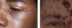 <p>Hutchinson’s sign- vesicles on the tip, side, or root of the nose indicates increased risk of ocular involvement</p><p>Painful, unilateral vesicular rash of forehead/upper eyelid that typically does not cross midline</p>