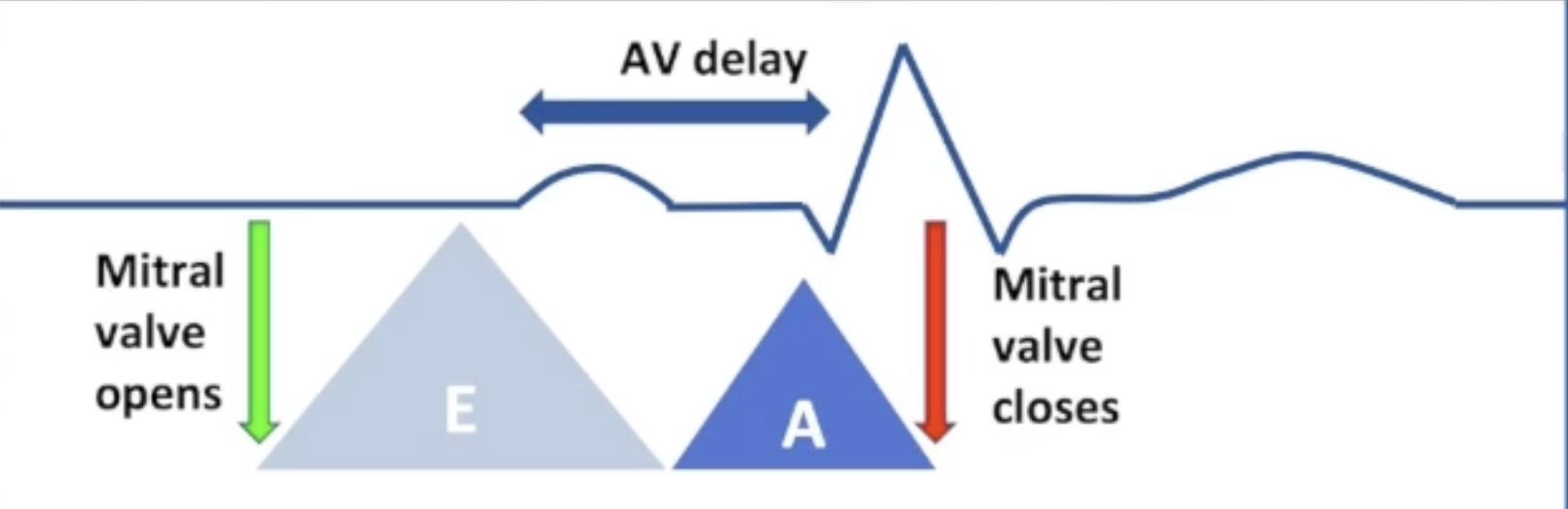 <ul><li><p>AV delay optimal:</p><ul><li><p>E wave begins after isovolumetric relaxation</p></li><li><p>A wave begins at end of E wave</p></li><li><p>Isovolumetric contraction begins at end of A wave</p></li></ul></li></ul><p></p>