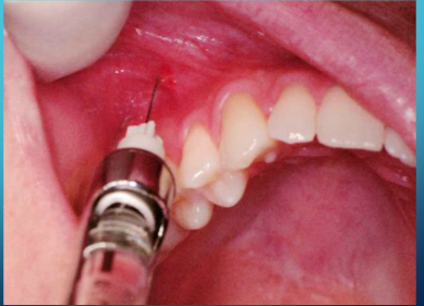 <p>27-gauge short or long</p><p>insertion: height of the mucobuccal fold above the second premolar</p><p>target: mx bone above the apex of the second premolar</p><p>landmark: mucobuccal fold over the second premolar</p>