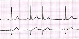 <ul><li><p>Extra heartbeat caused by excitation originating outside the SAN.</p></li><li><p>ECG shows an <strong>additional abnormal beat/wave</strong> between normal beats followed by long pause.</p></li><li><p>Often felt as a "missed" or "extra" heartbeat.</p></li></ul><p></p>