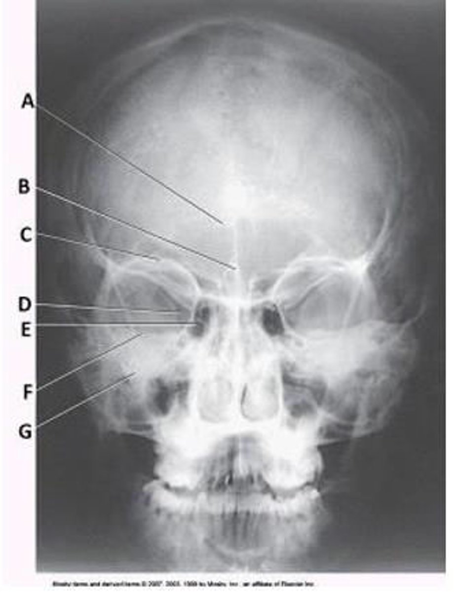 <p>What structure is labeled as letter B in the image below, used to evaluate the cranium?</p><p>a. Acanthion</p><p>b. Crista galli</p><p>c. Cribriform plate</p><p>d. Petrous ridge</p>