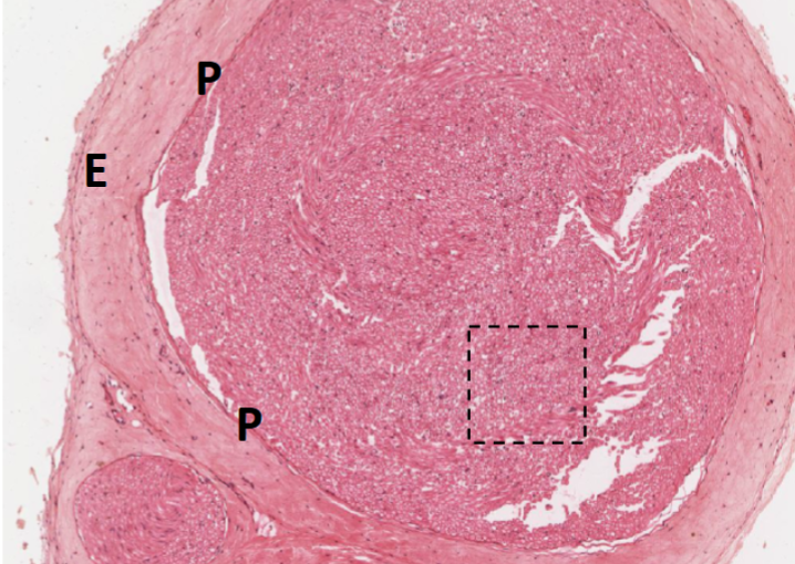 <p>the NEURIUMS </p><p>Epineurium/Perineurium </p><p></p>