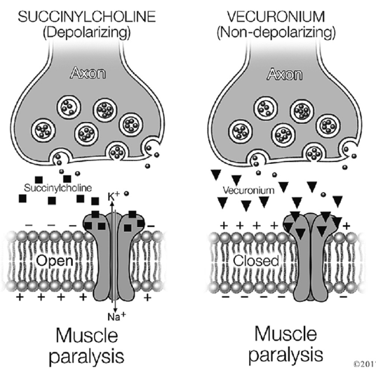 <p><span>•Neuromuscular Blocking Agents (NMBAs) = “paralytics”</span></p><p><span>•Use in RSI: airway muscle paralysis to allow for ETT placement</span></p><p><span>•However, affects all skeletal muscles, leading to full body paralysis for duration of paralytic agent</span></p><p><span>•Depolarizing NMBA binds AChR and triggers immediate action potential vs. nondepolarizing is competitive inhibitor of AChR</span></p><ul><li><p>Examples: </p><ul><li><p>Succinylcholine </p></li><li><p>Vecuronium or Rocuronium </p></li></ul></li></ul><p></p>