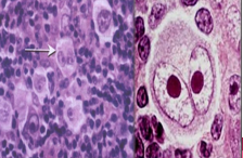 <ul><li><p>Affect the lymph nodes and blood</p></li></ul><ul><li><p>Indolent (less active) or Aggressive</p></li></ul><p>EX:</p><ul><li><p>Hodgkin lymphoma (mix of malignant and benign inflammatory cell types)</p></li><li><p>Non-Hodgkin lymphomas</p></li><li><p>Chronic Lymphocytic Leukemia (CLL)</p></li></ul><p></p><ul><li><p>Hematologic</p></li></ul><p></p>