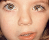 <p>What is the most likely diagnosis ?</p>