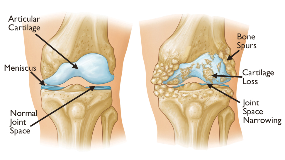 <p>A <strong>joint disease</strong> in which the <strong>protective cartilage in the joints wears down</strong>, causing <strong>pain and stiffness</strong>.</p>