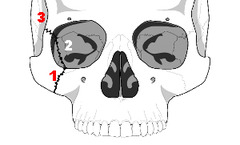 <p>separation of the zygoma from the remainder of the facial bones</p>