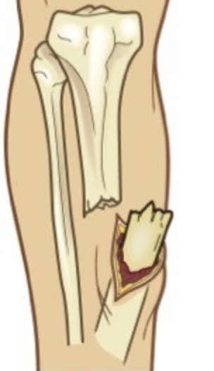 <p>Fracture communicating with the external environment due to severe trauma causing skin disruption, associated with <strong>high risk of contamination</strong>, <strong>infection</strong>, and <strong>soft tissue injury</strong>, assessed using the <strong>Gustilo-Anderson classification</strong>.</p>