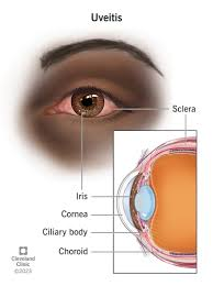 <p>PP: inflammation of choroid+ciliary body+iris</p><p>E: idiopathic<br>autoimmune<br>inflammatory</p><p>CM: UL or BL<br>red<br>painful<br>light sensitive</p><p>TX: topical steroid<br>pain→cycloplegic<br>referral</p>