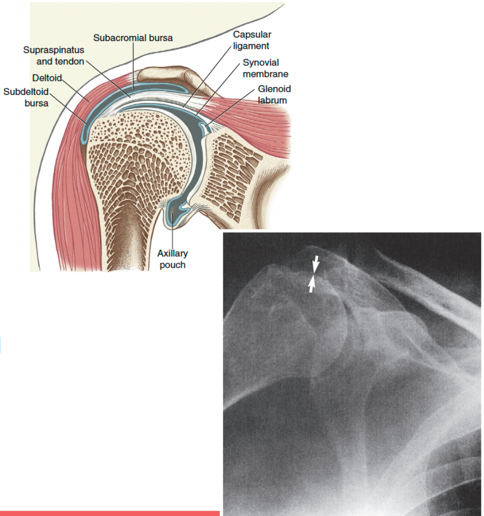 <p>humeral head can translate upward and close subacromial space when doing overhead reaching with poor mechanics </p>
