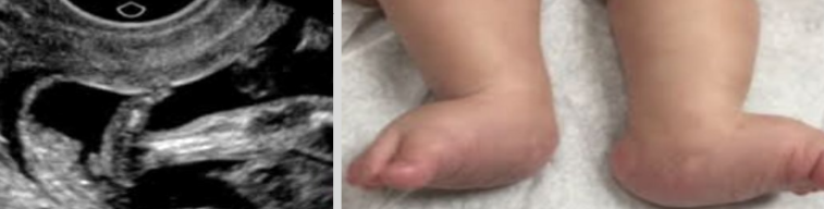 <p><span style="background-color: transparent;">Associated with trisomy 13, trisomy 18, and spina bifida</span></p>