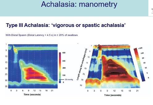 <p>Lijkt op perstaltiek, maar de slokdarm trekt als een soort blok heel hevig samen.</p><p style="text-align: left;"><strong><em>Dit is de spastische vorm van achalasia.</em></strong></p><p style="text-align: left;">Het is geen peristaltische golf.</p><p style="text-align: left;"></p><p style="text-align: left;">De contractie treedt simultaan op, maar duurt op bepaalde momenten langer.</p><p style="text-align: left;">Je voedsel raakt ook vast en stagneert, wat de drukopbouw verhoogt.</p>