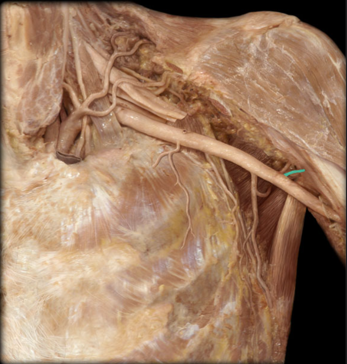 <ul><li><p><strong>Origin: </strong>Axillary</p></li><li><p><strong>Course: </strong>Passes anteriorly around surgical neck of humerous</p></li><li><p><strong>Distribution: </strong>Deltoid muscle, Anterior proximal arm muscles, and Shoulder joint</p></li><li><p><strong>Comment:</strong></p><ul><li><p>Smaller than posterior circumflex humeral</p></li><li><p>Anastomosis with posterior circumflex humeral</p></li><li><p>Anastomosis refers to the end-to-end union of vessels</p></li><li><p>Surgical neck of humerus is proximal portion of shaft (common area of fracture)</p></li></ul></li></ul><p></p>