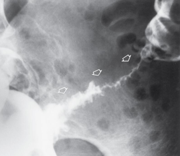 <p>Inflamed infected diverticula; leading to bleeding, necrosis, perforation, abscess, fistulas.</p>