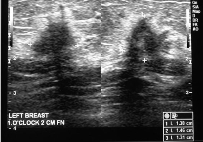 <p>What is the pathology on this breast US</p>