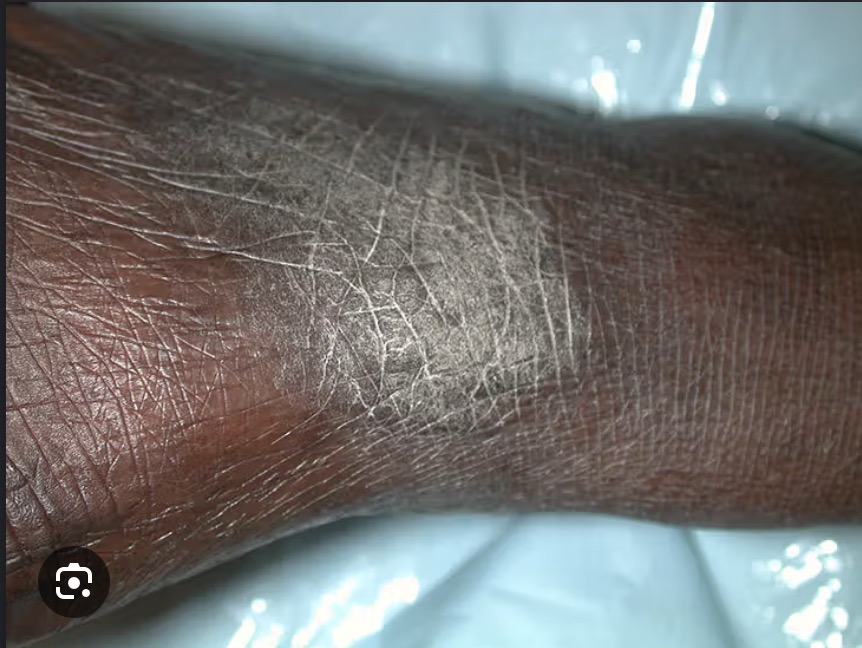 <ul><li><p>Secondary Skin Lesion</p></li><li><p>thickened “moss like” skin from prolonged scratching</p></li></ul><p></p>