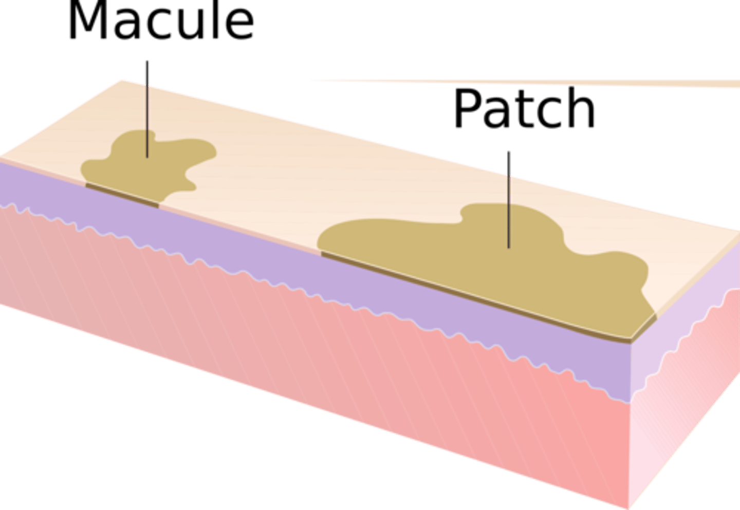 <p>circumscribed flat, discoloration, >1cm</p>