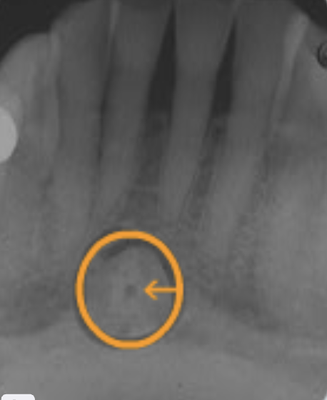 <p>lingual foramen</p>