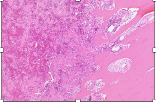 <p>Tumeur du fémur chez un patient de 15 ans </p><p>Diagnostic</p><p>Définition</p><p>Age</p><p>Topographie</p><p>Anatomie</p><p>Clinique</p><p>Histologie</p><p>Moléculaire </p>