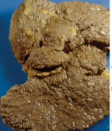 <p>death of liver cells stimulates scar formation</p><p>blood vessels carrying ozygen are cut off</p><p>very long time to develop and rare</p><p></p>