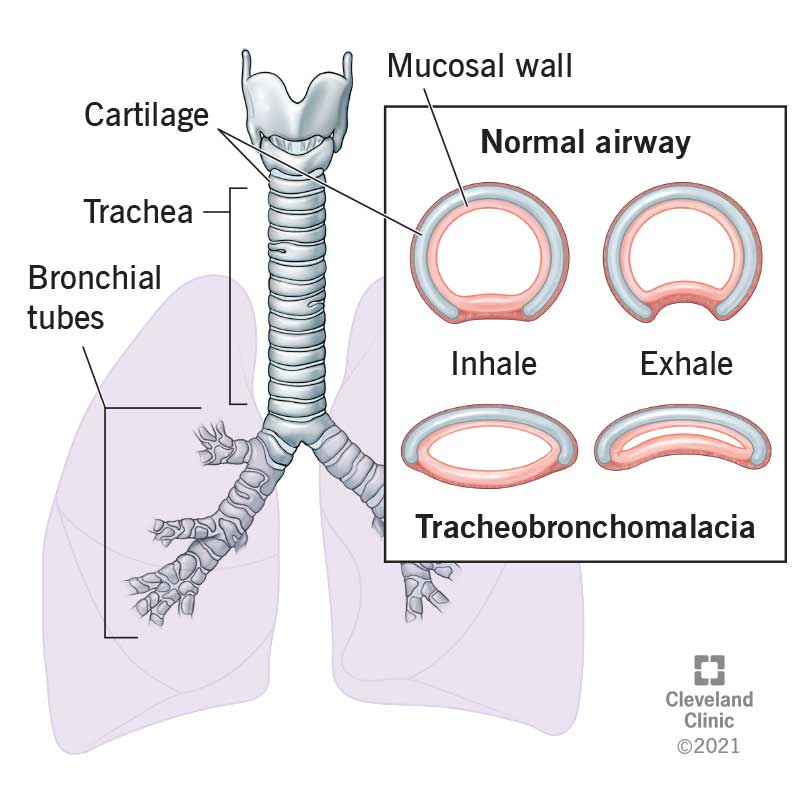 <ul><li><p><span>airway collapse during expiration due to insufficient rigidity of the cartilaginous framework of the trachea-bronchial tree – usually presents within 12/12 of life, biphasic stridor, expiratory wheeze, recurrent LRTI, cough, cyanotic episodes and apneas</span></p></li><li><p><span>Management of critical airway obstruction will depend upon the pathology but may often require surgical management with ENT using rigid bronchoscopy under GA with inhalational induction and spontaneous breathing (which may be difficult given risk of worsening dynamic airway obstruction with anaesthesia) – or alternatively paediatric tracheostomy (which is difficult and associated with significant morbidity and mortality)</span></p></li></ul><p></p>