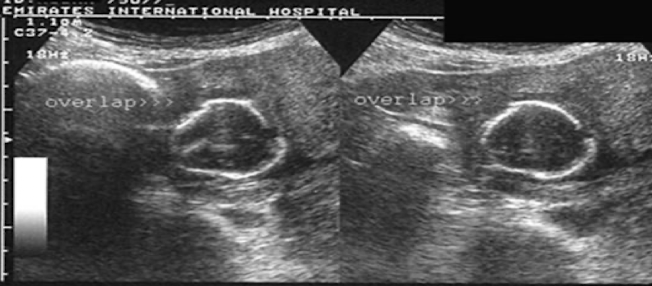 <p>flattened and misshapen fetal head with overlapping of cranial bones</p><ul><li><p>associated with <strong>fetal demise</strong></p></li></ul><p></p>