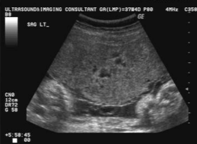 <ul><li><p>diabetes</p></li><li><p>anemia</p></li><li><p>hydrops</p></li><li><p>torch infections</p></li></ul><p></p>