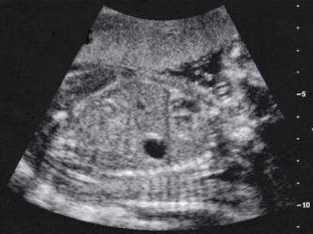 <p>Primitive lungs mature and become capable of functioning sometime after 25 weeks of gestation; lecithin-to-sphingomyelin ratio (LS ratio) measures ability of lungs to function; lings appear homogeneous, mid-gray echogenicity</p><p>Diaphragm: appears slightly concave with cuplike portion opening toward abdomen and arched position pointing toward thorax; it is not unusual to see diaphragm move with fetal respiration, especially during latter half of 3rd trimester</p>