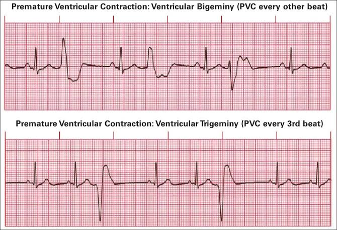 <p>ventricular premature beats</p>