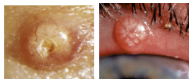 <p>What is the most likely diagnosis ?</p>
