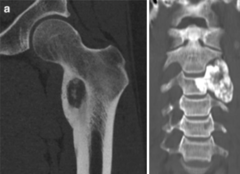 <p>What is this?</p><p>- < 20 yo</p><p>- Pain (Not relieved by aspirin)</p><p>- Neural arch</p>