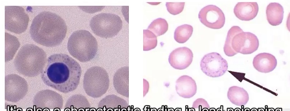 <p>-lead toxicity and beta thalassemia major; residual RNA in red cells</p>