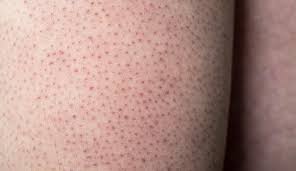 <p>keratosis pilaris</p>