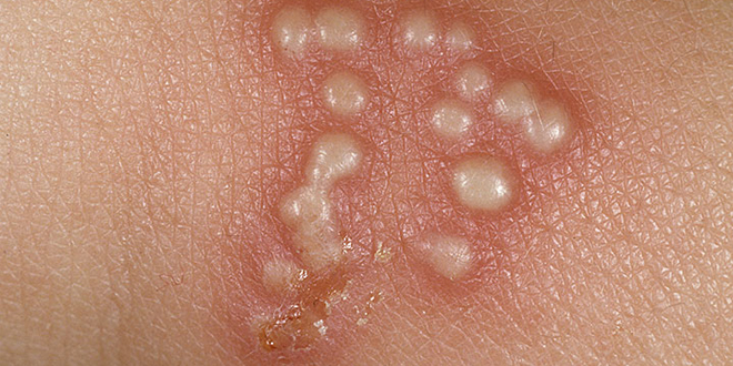 <p>STI due to HSV 2</p><p>-Presentation: painful genital ulcers often preceded by prodromal symptoms of burning, paresthesias, numbness, dysuria, and fever. Physical exam reveals multiple, shallow, tender ulcers that are grouped on an erythematous base </p><p>-Dx: PCR, Tzanck smear shows multinucleated giant cells </p><p>-Tx: Acyclovir</p>