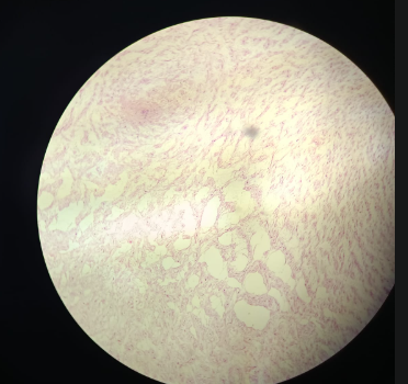 <p>Umbilical Cord - HE</p><ul><li><p>structure which carries out blood vessels (looks like Loose connective tissue)</p></li><li><p>3 types of blood vessels:</p><ul><li><p>1. venaumbilicaries</p></li><li><p>2. arterieumbilicaries</p></li></ul></li><li><p>Epithelium: Amion, simple cuboidal epithelium</p></li><li><p>Wharton Jelly - very soft tissue, built of small non-refinigated microcollagen type 1 fibers</p></li><li><p>Stem cells: triangular shaped from the umbilical cord </p></li><li><p>Empty space is filled with ground substance </p></li><li><p>Umbilical cord is very</p></li></ul><p></p>