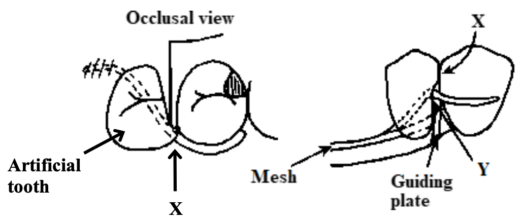 <p>For best appearance, the natural and artifical teeth at “X” should contact, but not be tightly adapted under a wire clasp “Y” why?</p>