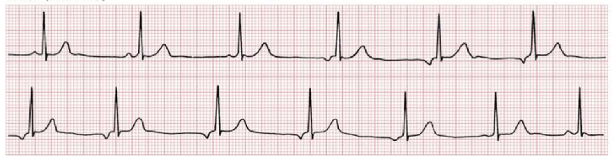 <p>howd yk that is a Wandering Atrial Pacemaker</p>