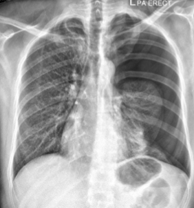 <p>what is the abnormality is noted on the patient’s left side in this image?</p>