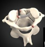 <p><strong>Comminuted atlas fx</strong> as a result of axial loading, e.g. landing on one’s head or abruptly on one’s feet</p><ul><li><p><strong>Ant. and post. arches</strong> of C1 are fx</p></li><li><p>Post-op halo</p></li></ul><p></p>