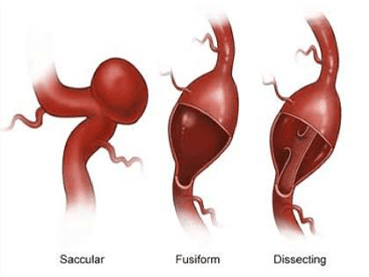 <p>B. saccular</p>