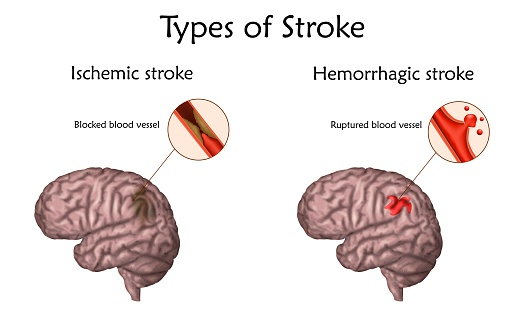 <p><span style="line-height: 107%;"><strong>BOOK:</strong></span></p><p class="MsoNormal"><span style="line-height: 107%;">Loss of body function that results from a blood clot or another change in arteries in the brain that affects blood flow and leads to death of brain tissue; also called a cerebrovascular accident.</span></p><p class="MsoNormal"><span style="line-height: 107%;"><strong>SIMPLE:</strong></span></p><p class="MsoNormal">A condition in which <span style="font-family: Calibri, sans-serif;">blood flow to part of the brain is interrupted or reduced</span>, causing <span style="font-family: Calibri, sans-serif;">damage to brain cells</span>.</p>
