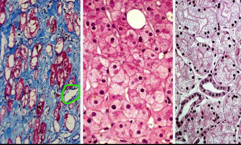 <p>ląstelės patinimas dėl skysčių kaupimosi citoplazmoje</p>