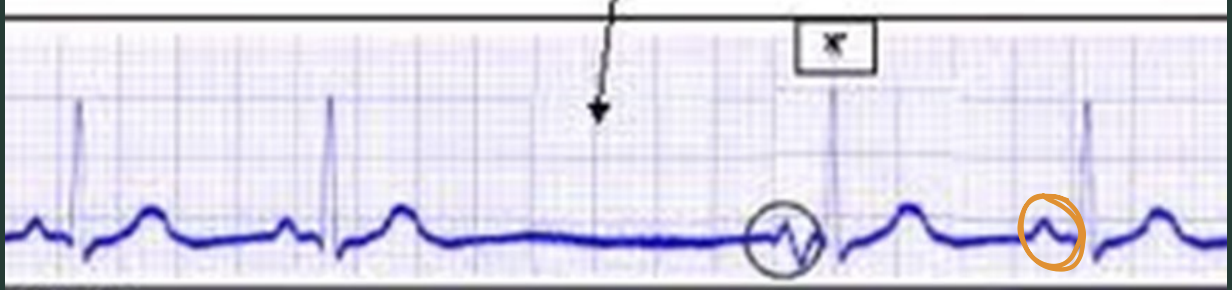 <p>What does this ECG show?</p>