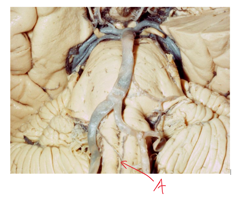 <p>What kind of nuclei damage, and hence symptoms can we expect to see from damaging artery A? what is the name of this syndrome?</p>