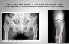 <p>Medial aspect of the cortex of long bones</p>