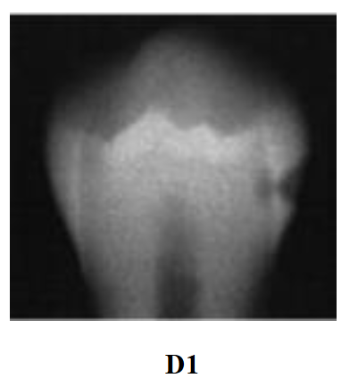 <p>Radiolucency in the outer third of dentin</p>